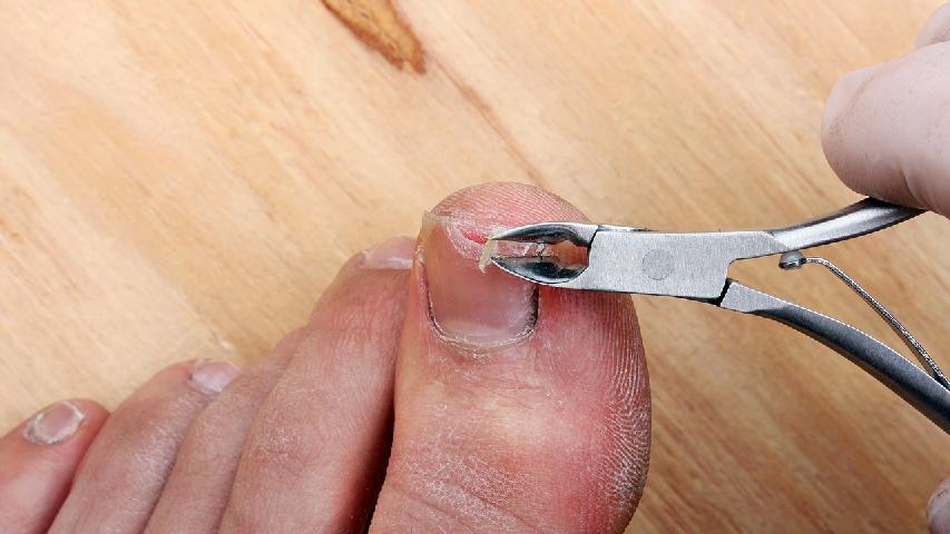 灰指甲应该与哪些疾病相鉴别?