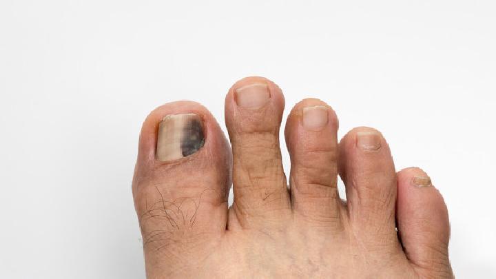 灰指甲发病过程的七大症状表现