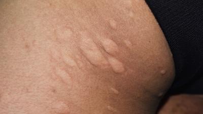 痤疮形成的原因一般是什么