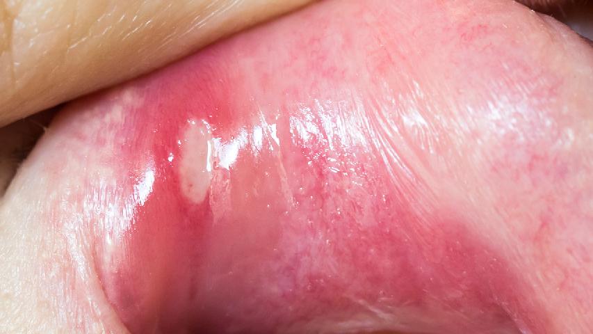 小心口腔溃疡悄悄接近你