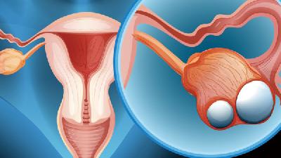 卵巢囊肿的原因多发生于未产妇或未生育妇