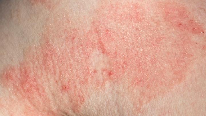 蝶形红斑或盘状红斑是红斑狼疮症状之一