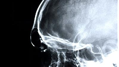 精神异常属于脑癌的早期症状吗