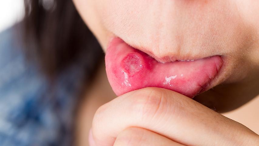 口腔溃疡都有哪些症状表现呢