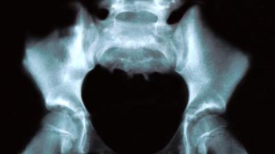 专家分析不同分类的坐骨神经痛的症状