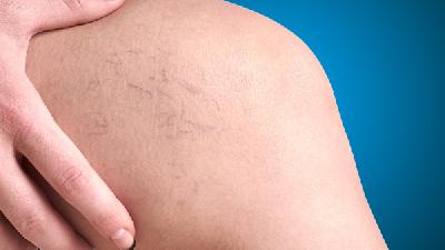 让您详细了解什么是静脉曲张?