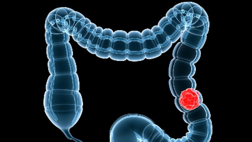 大肠癌的症状可以从早期发展为晚期