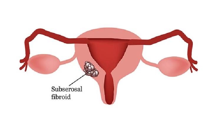 子宫肌瘤的症状可引起女性较强烈的下腹痛