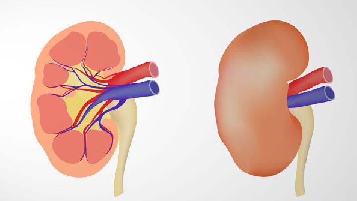 腎絞痛是腎結石里的癥狀表現(xiàn)嗎