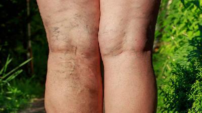 了解静脉曲张的病因对治疗有帮助