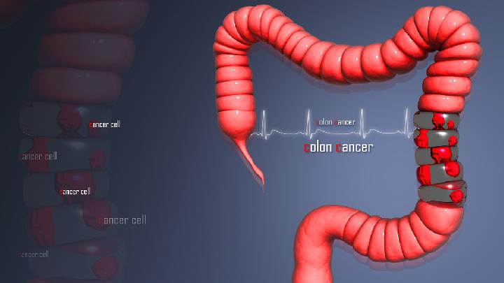 得了結(jié)腸癌可能會出現(xiàn)一系列腸梗阻癥狀