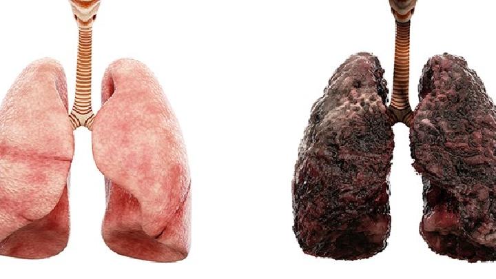 如何区分肺癌早期肺内症状