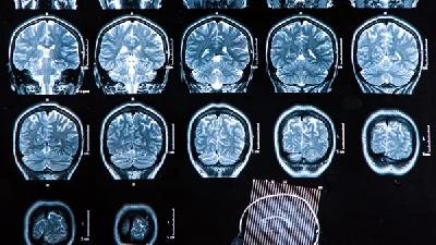 什么是主要的脑萎缩的诊断法