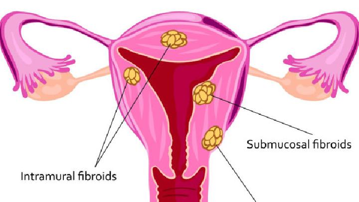 患了子宫肌瘤极有可能会出现月经改变