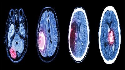 最主要的诱发出现的脑癌的病因的因素