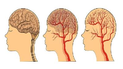 脑萎缩可能还会和生理因素有关系