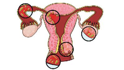 卵巢癌比较突出的表现包括腹痛、腰痛