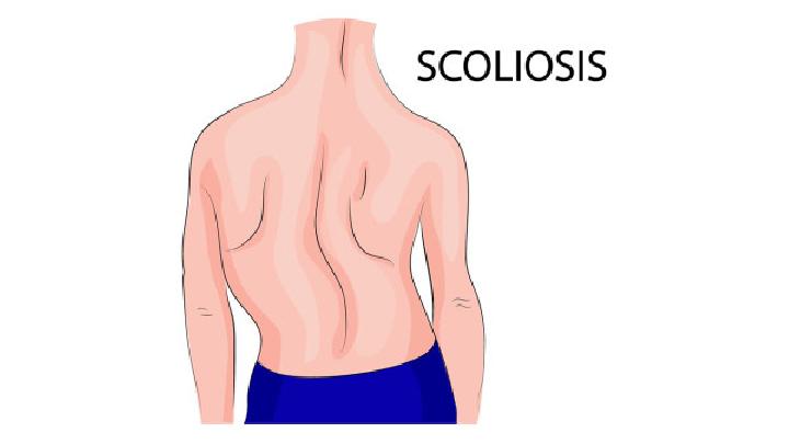 带大家详细了解治疗脊柱畸形的方法