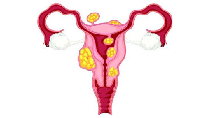 输卵管积脓/输卵管卵巢积脓的诊断与鉴别