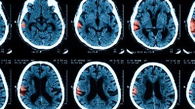 三种有效的脑萎缩的诊断方法