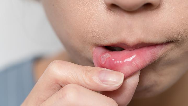 生活中常见的口腔溃疡的症状特点