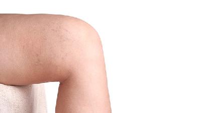 风湿病比较重要的症状还有关节炎