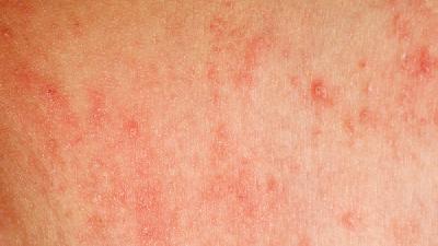 痤疮有哪些有效的治疗方法?