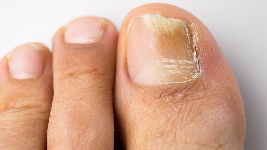 甲沟炎不及时处理易诱发骨髓炎
