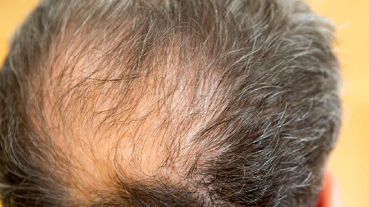 男性脂溢性脱发是怎么一回事?