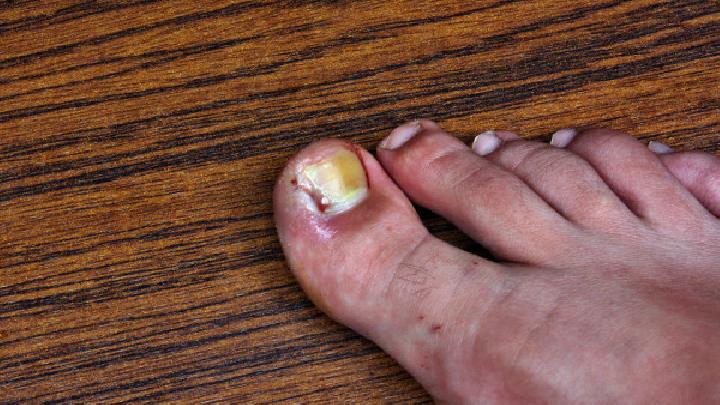 患了灰指甲会产生哪些危害呢?