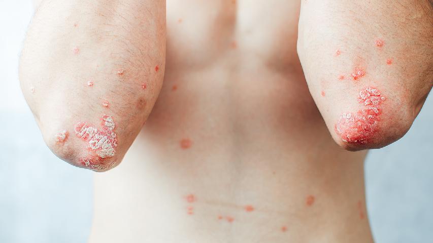 牛皮癣患者照顾好你的皮肤