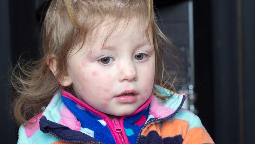 小儿荨麻疹的病因可能是物理刺激引起的