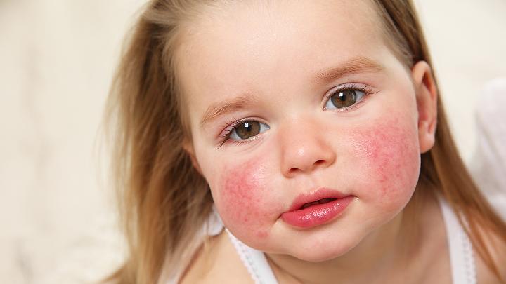 小儿荨麻疹的病因可能是物理刺激引起的