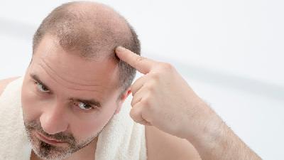 脂溢性脱发严重时会导致秃顶的现象