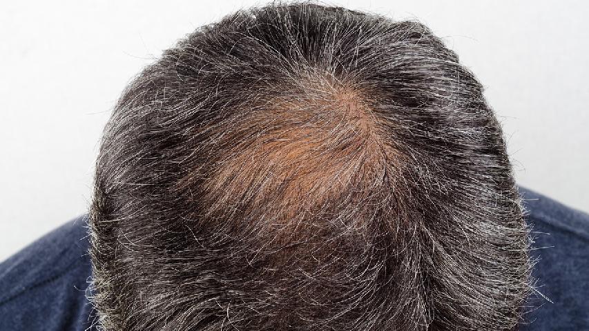 不同种类的脱发的症状会有什么不同呢