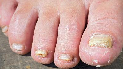 经常出现的灰指甲的症状表现的细分