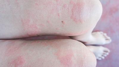 小儿湿疹经常会出现的症状表现