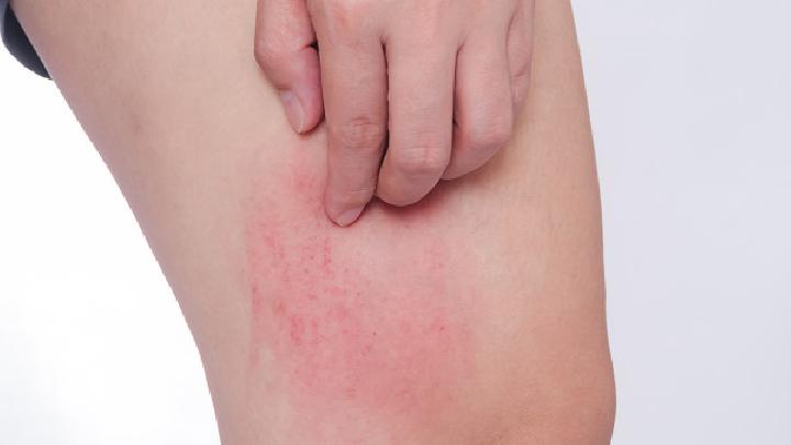 注意：皮肤划痕症是人工荨麻疹的临床表现