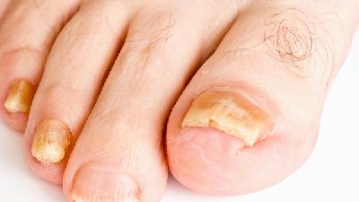 在严重时可引起疼痛和不适的灰指甲的危害