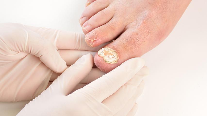 有了灰指甲的诊断方可及时发现患者病情
