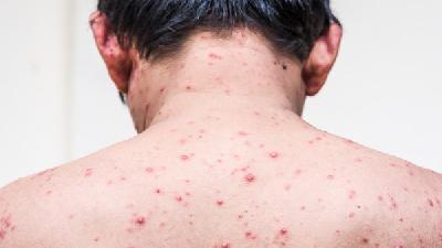 让青少年头疼的痤疮的发病原因