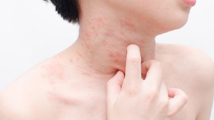 出现红色疹子可为皮肌炎的早期症状