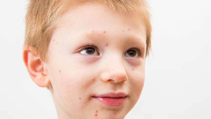皮肤划痕症是最常见的人工荨麻疹病因