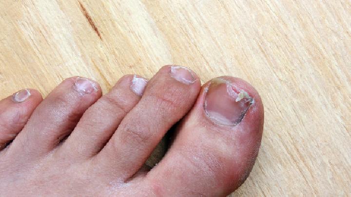 最易常出现的患上灰指甲的危害表现