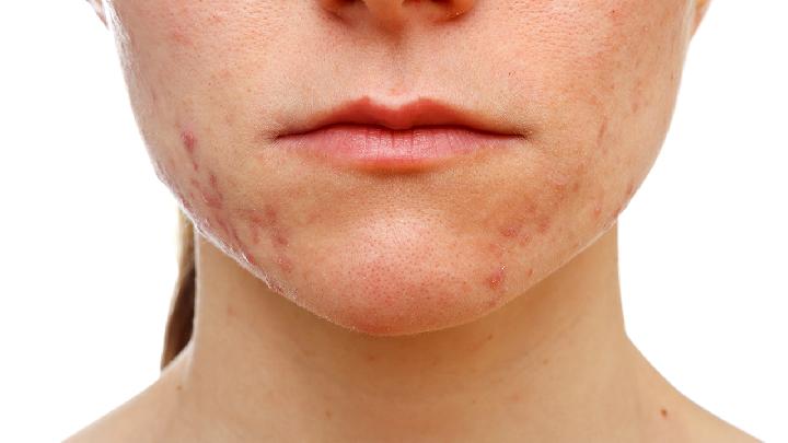你的肌肤是不是缺水了? 6个方法帮你改善干燥皮肤
