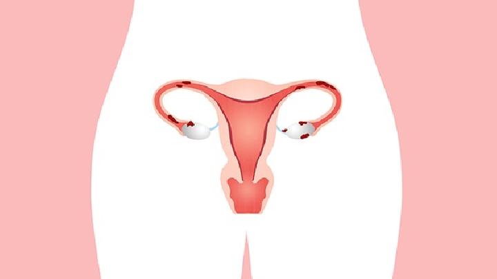 预防卵巢囊肿要注意三大保健