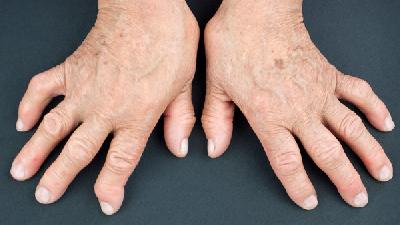 什么才是主要的患上风湿性关节炎的症状