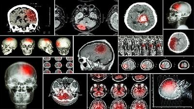 脑癌疾病的出现主要被什么病因所致
