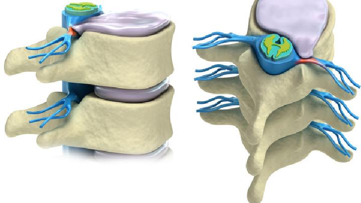 脊柱畸形的常见症状的一些表现