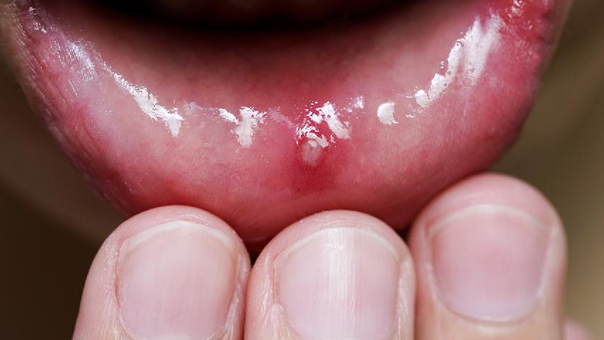 常见的口腔溃疡的症状有哪些表现